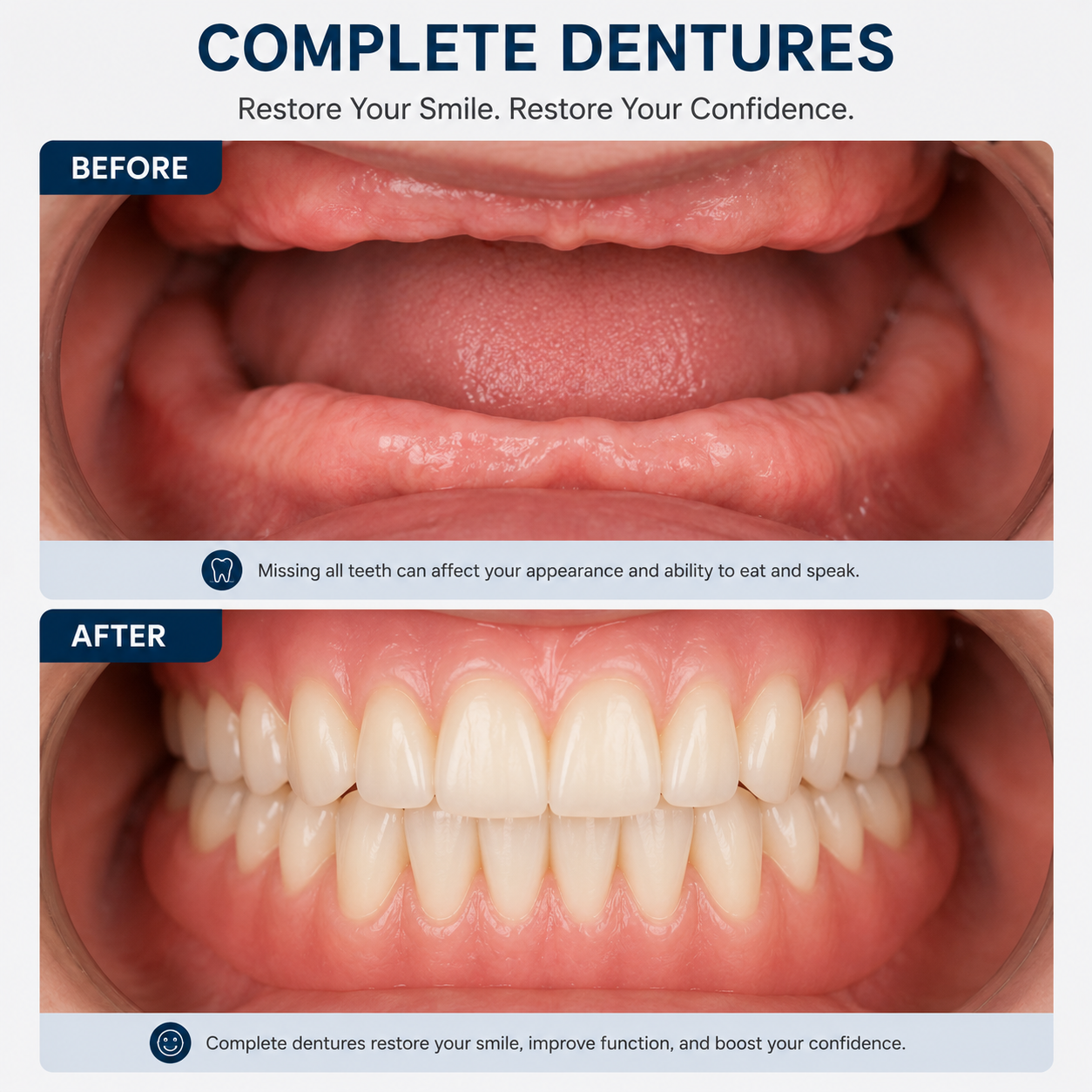 Traditional complete dentures vs implant overdentures Kanyakumari