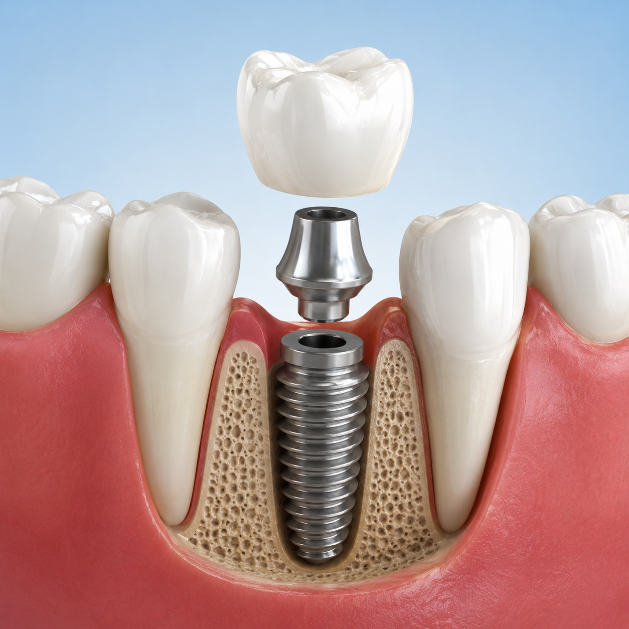 Dental implant aftercare tips Kanyakumari