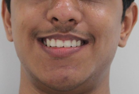 After orthodontic braces treatment at Darshan Dental Kanyakumari