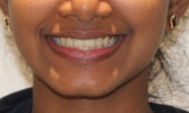 After smile transformation at Darshan Dental Kanyakumari