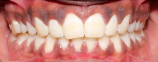 After smile transformation at Darshan Dental Kanyakumari