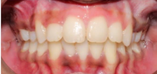 After smile transformation at Darshan Dental Kanyakumari