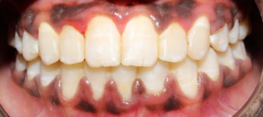 After smile transformation at Darshan Dental Kanyakumari