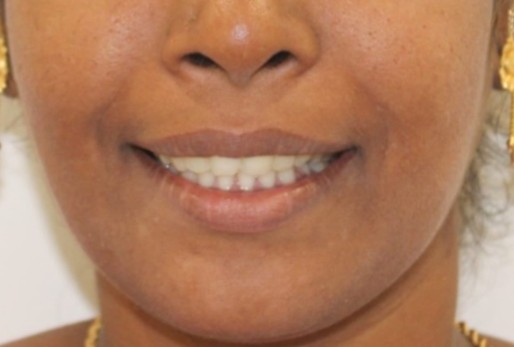 After cosmetic smile makeover at Darshan Dental Kanyakumari