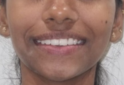 After dental implant restoration at Darshan Dental Kanyakumari