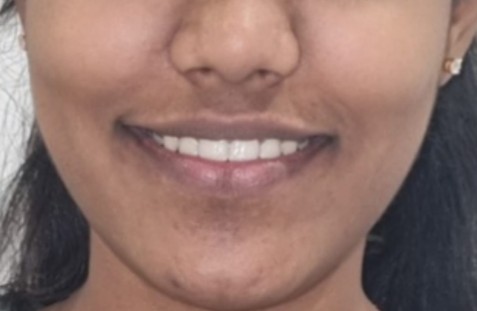 After deep scaling and teeth whitening at Darshan Dental Kanyakumari