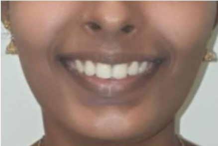 After smile transformation at Darshan Dental Kanyakumari