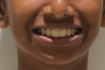 After implant and crown restoration at Darshan Dental Kanyakumari