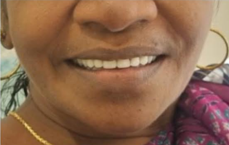 After teeth whitening at Darshan Dental Kanyakumari