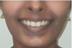 After orthodontic braces at Darshan Dental Kanyakumari