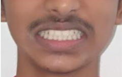 After dental implant restoration at Darshan Dental Kanyakumari