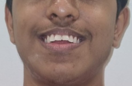 Before orthodontic braces treatment at Darshan Dental Kanyakumari