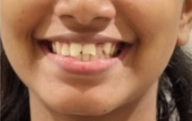 Before smile transformation at Darshan Dental Kanyakumari