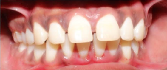 Before smile transformation at Darshan Dental Kanyakumari