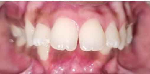 Before smile transformation at Darshan Dental Kanyakumari