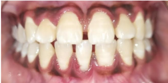 Before smile transformation at Darshan Dental Kanyakumari