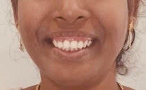 Before cosmetic smile makeover at Darshan Dental Kanyakumari