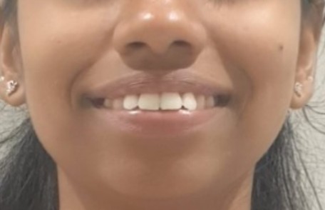 Before dental implant restoration at Darshan Dental Kanyakumari