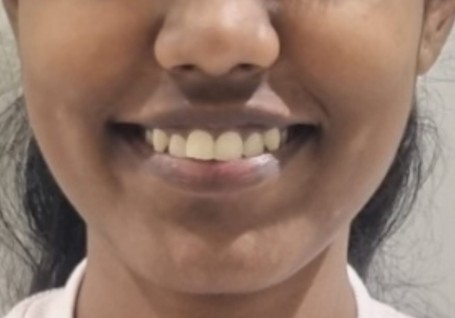 Before deep scaling and teeth whitening at Darshan Dental Kanyakumari