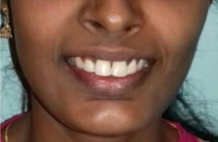 Before smile transformation at Darshan Dental Kanyakumari