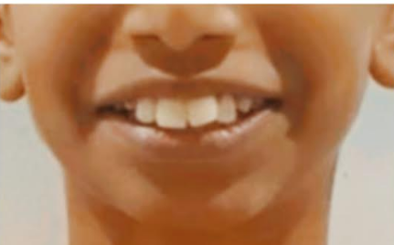 Before implant and crown restoration at Darshan Dental Kanyakumari