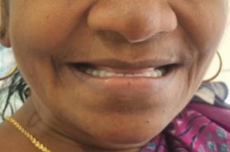 Before teeth whitening at Darshan Dental Kanyakumari