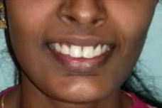 Before orthodontic braces at Darshan Dental Kanyakumari