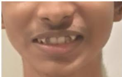 Before dental implant restoration at Darshan Dental Kanyakumari