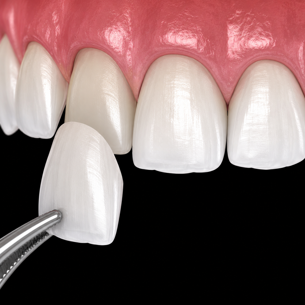 Veneers smile makeover guide Kanyakumari